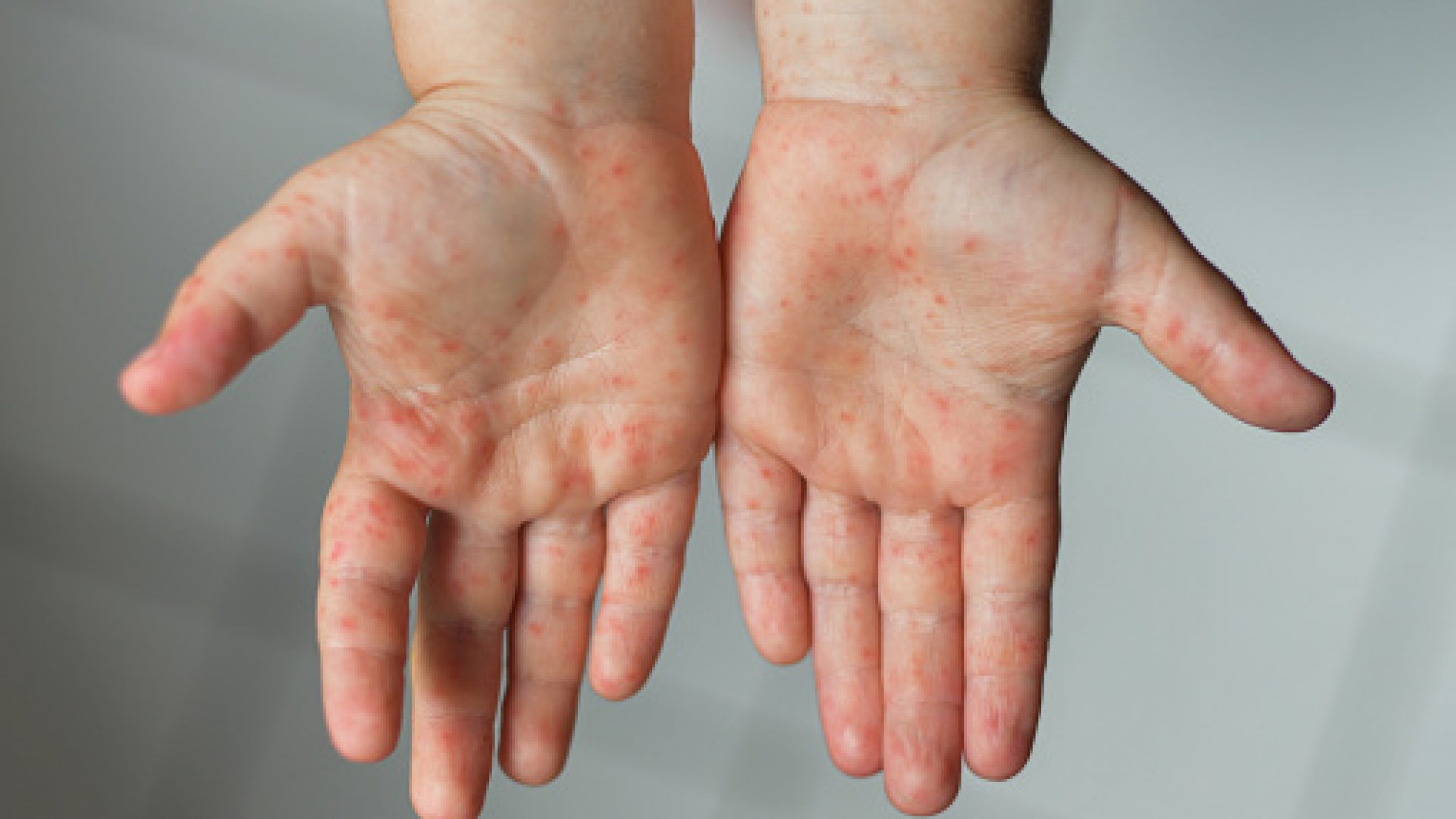 Informa OMS de nuevos casos de enterovirus en Europa