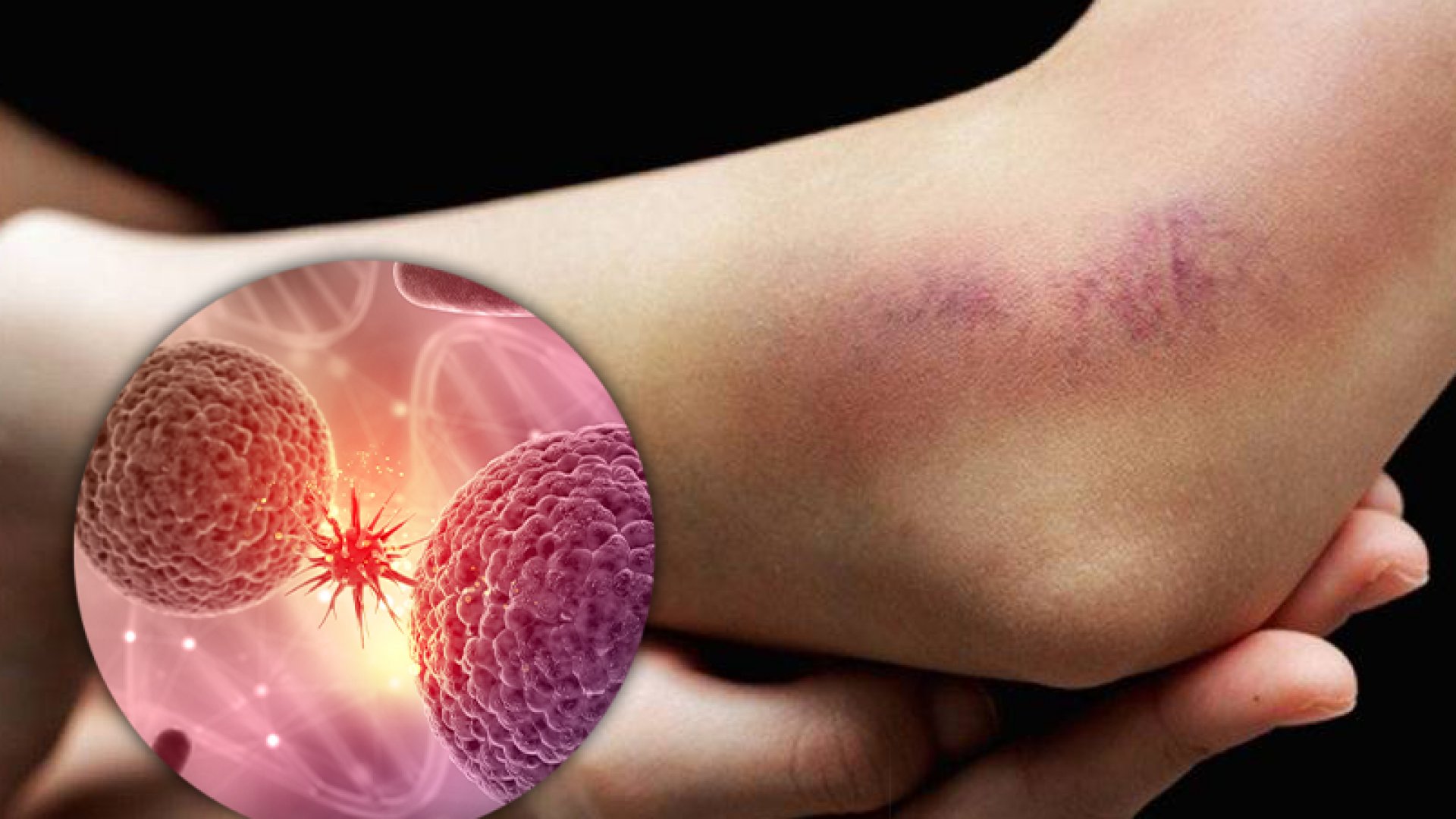 Día Mundial de la Leucemia Mieloide Crónica