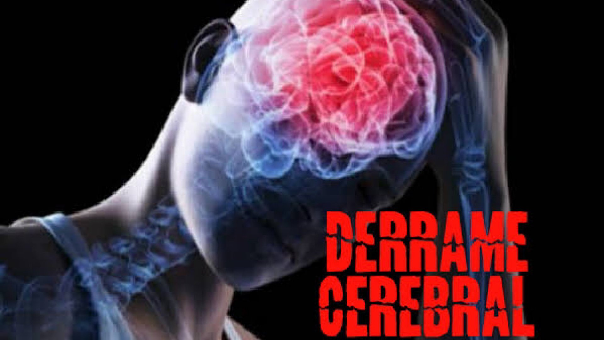 Infarto cerebral es la segunda causa de discapacidad en México 
