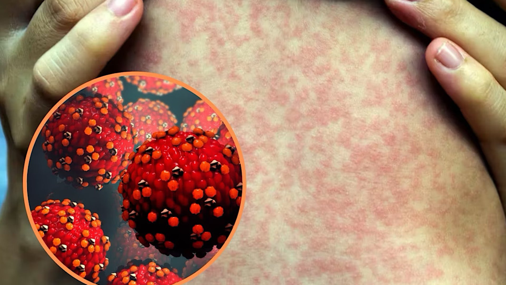 UNAM alerta sobre temporada de virus altamente contagioso