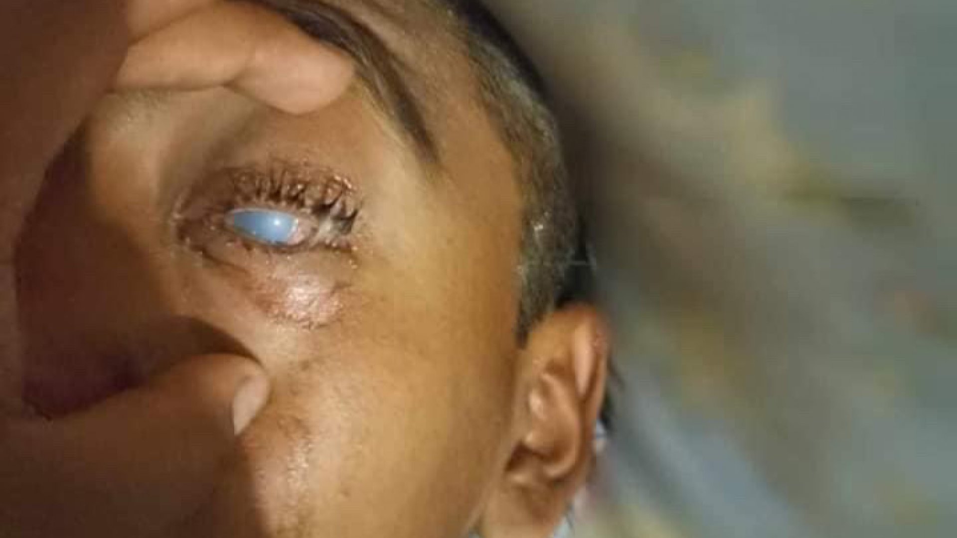 Investigan caso de menor que perdió la vista en San Juan Guelavía