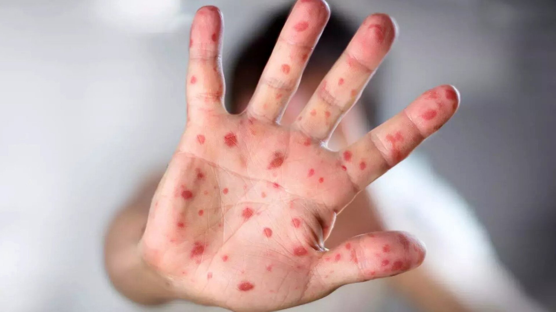 México emite alerta epidemiológica por sarampión