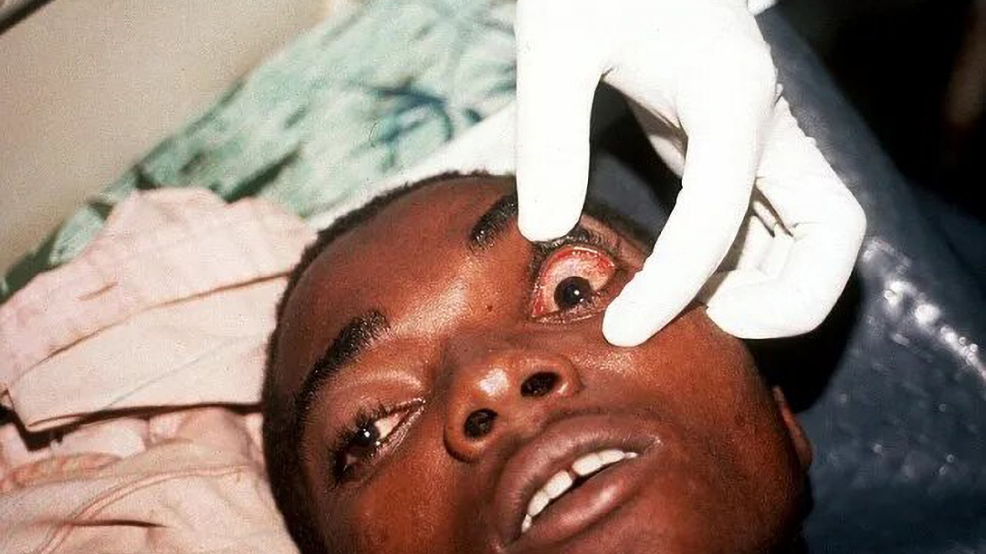 Alerta por nuevo virus parecido al Ébola que hace sangrar los ojos