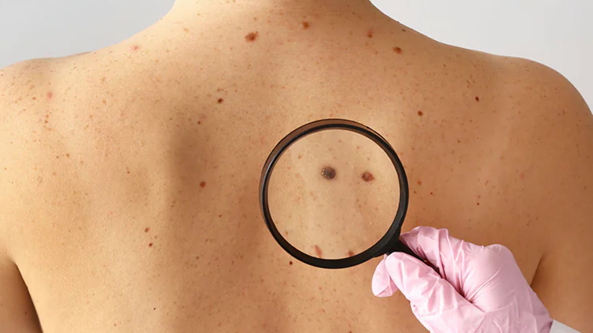 Autoriza Cofepris ensayo clínico para vacuna contra melanoma