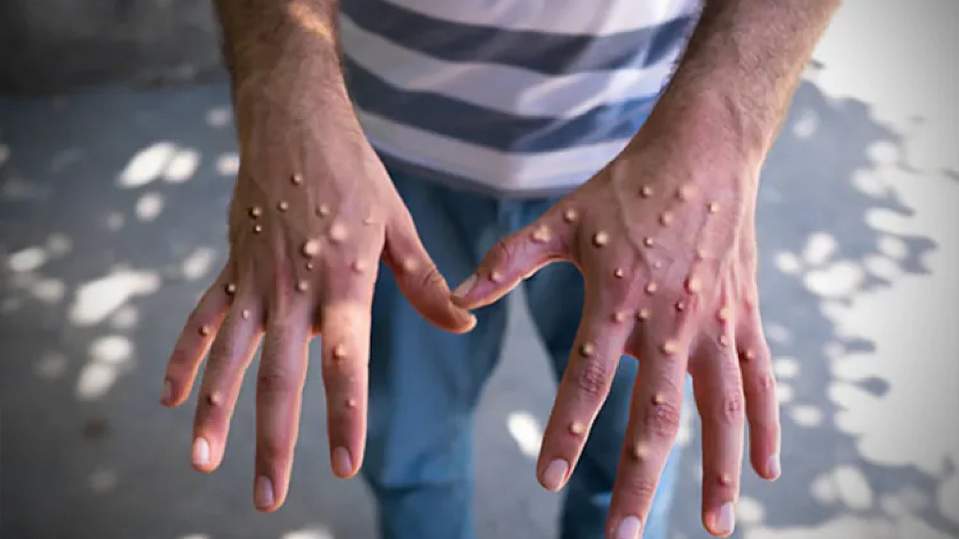 No hay casos de mpox de la nueva variante clado 1b en México: Salud