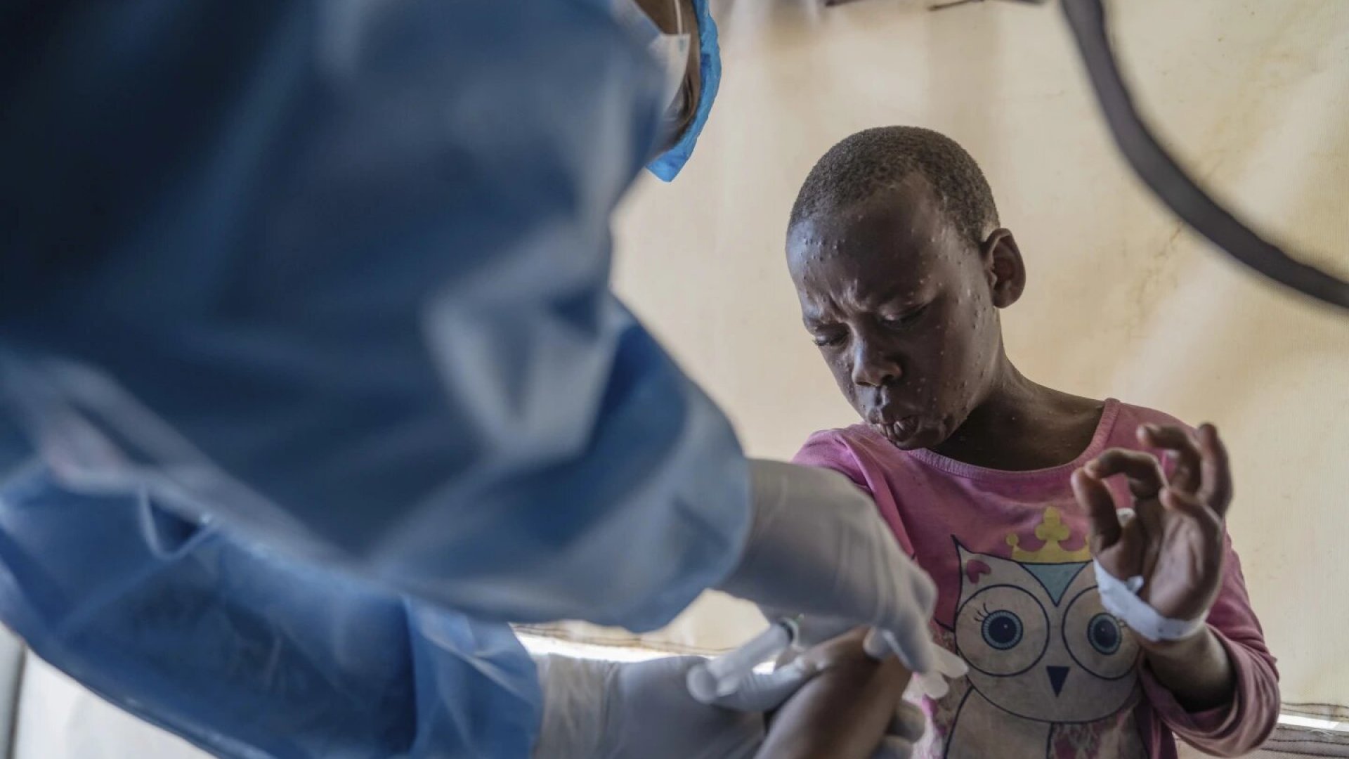 Los brotes de Mpox en África se deben a décadas de negligencia