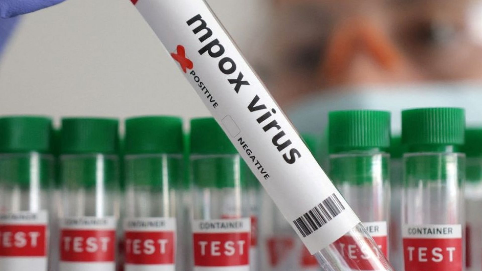 Detectan en Alemania un caso de la nueva variante de mpox