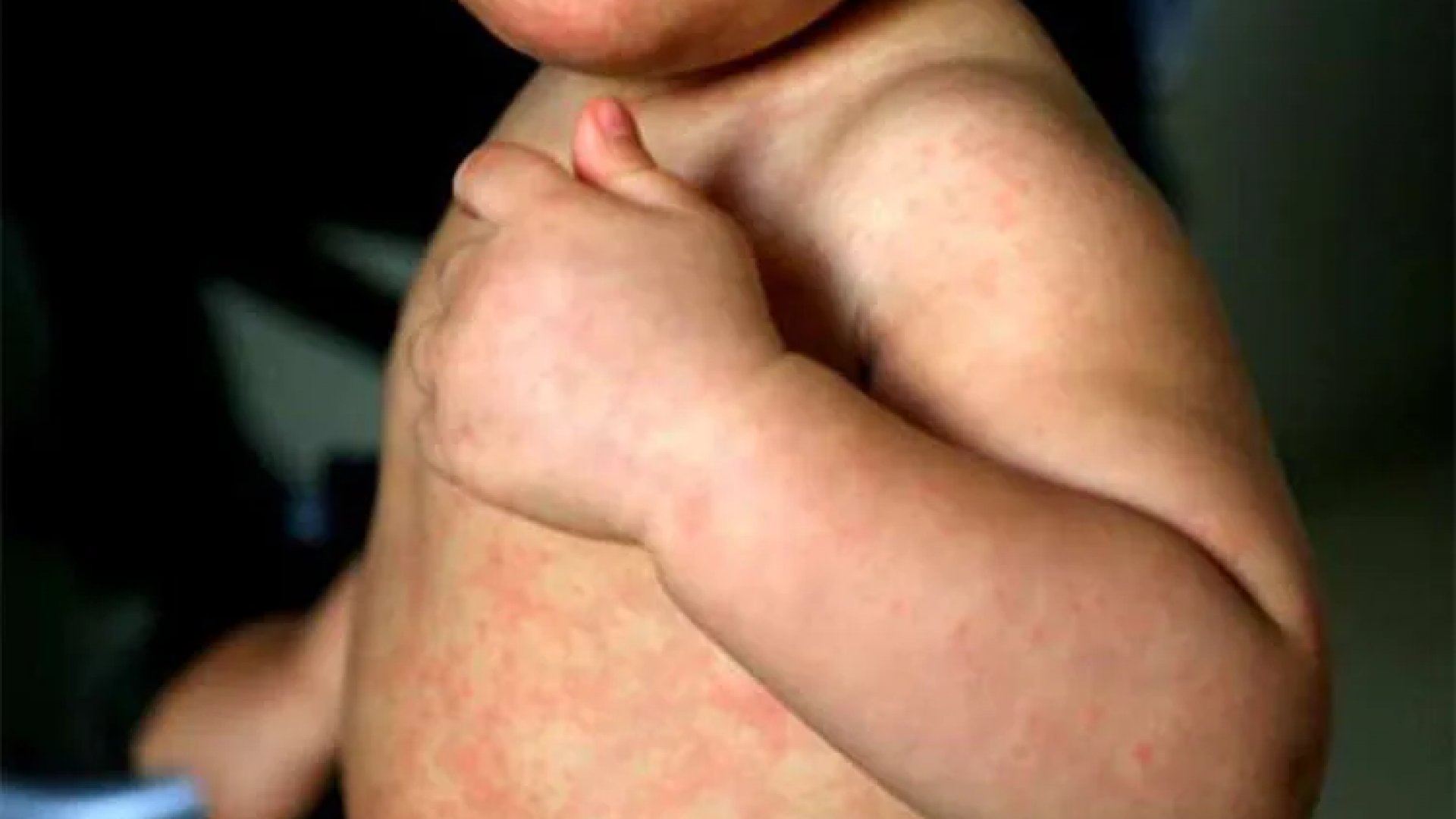 Casos de sarampión aumentan 20% en el mundo, alerta la OMS