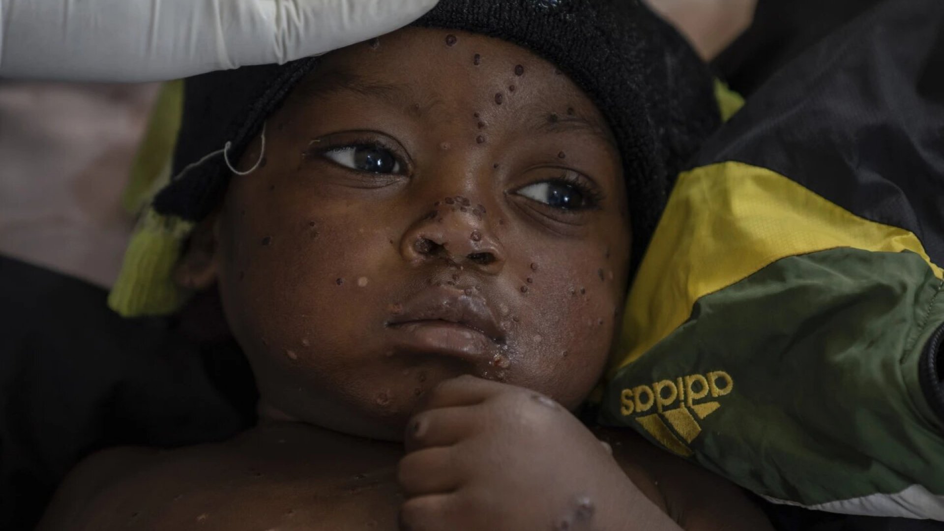 MPOX: OMS aprueba nueva vacuna para evitar propagar el virus