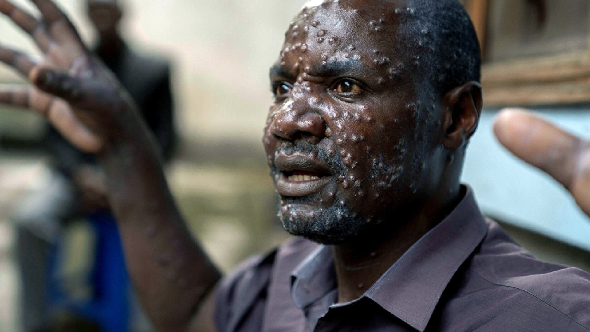 OMS mantiene emergencia sanitaria internacional por mpox ante aumento de casos en África