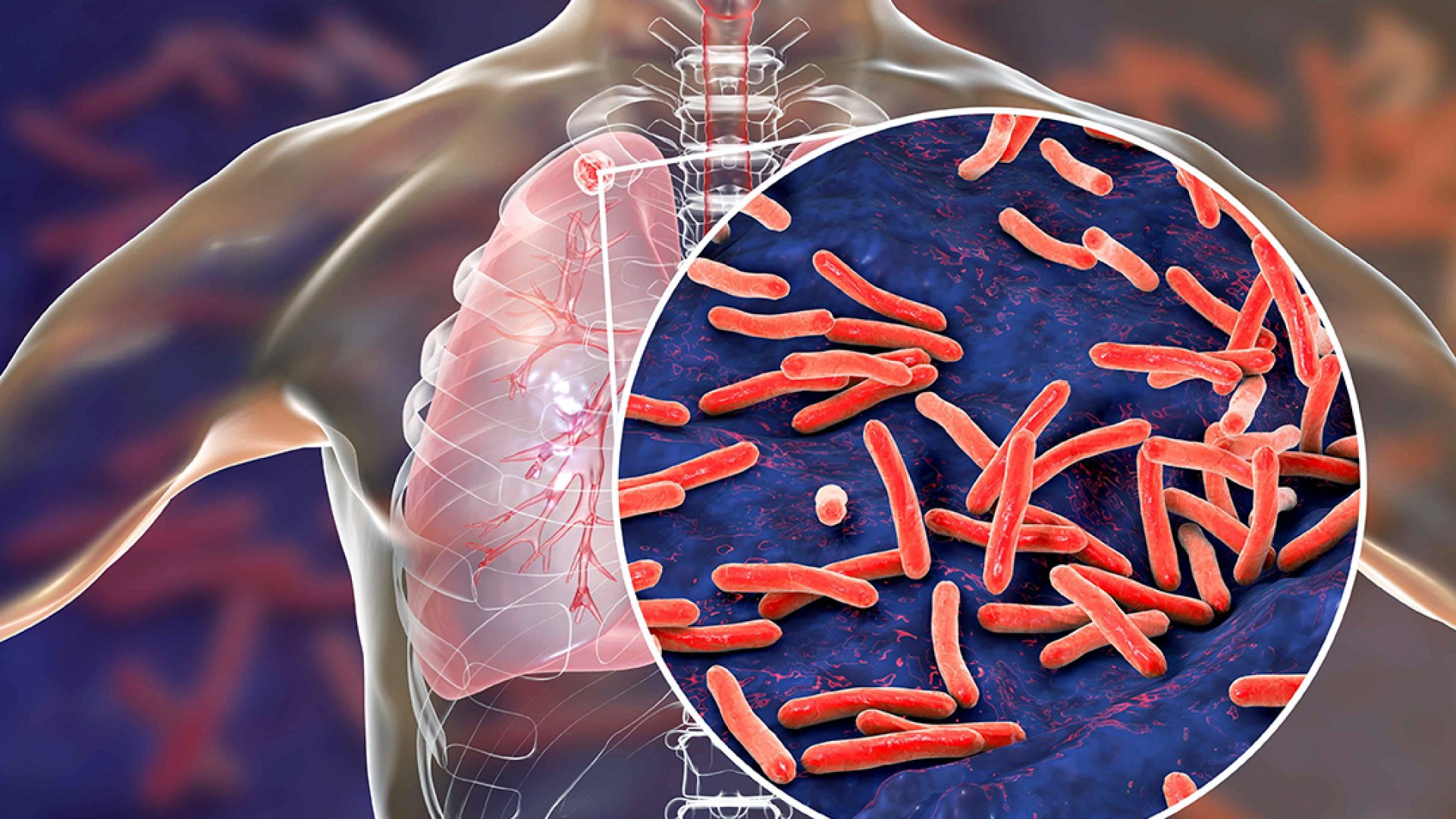 "No hay brote de tuberculosis en SEV": Salud